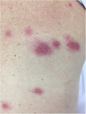 Sweet’s syndrome. Multiple erythematous papular infiltrated lesions with a pseudovesicular aspect in Sweet’s syndrome.
