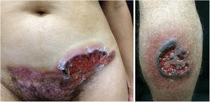 Pyoderma gangrenosum. Right: ulcerated lesion, with irregular, inflammatory and raised margins, dark red or purple in color and necrotic base (active lesion in pyoderma gangrenosum). Left: deep ulcer containing fibrin at the periphery, without a purplish edge (older lesion, in an area of C-section scar).