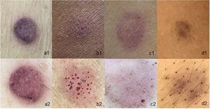 Usefulness of dermoscopy in patch tests that contain pigment: (a1), Naked-eye paraphenylenediamine test, with doubtful reaction; (a2), Paraphenylenediamine test with weak reaction (1+); (b1), Patient phototype V with reaction to nickel observed with the naked eye, with mild erythema; (b2), The same patient with dermoscopy showing well-defined erythema and pore reaction; (c1), Reaction to Disperse Blue observed with the naked eye, with doubtful reaction; (c2), Reaction to Disperse Blue with dermoscopy showing only pigment deposition without erythema (negative reaction); (d1 and d2), Test with Paraphenylenediamine, observed with the naked eye and with dermoscopy, showing only pigment deposition without erythema (negative reaction).