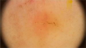 Dermoscopic image of scabies showing a brownish triangular structure followed by a whitish linear structure forming the “jet with contrail” image. (FotoFinder, original magnitude ×20) Source: Authors' personal collection.