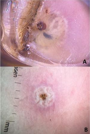 Dermoscopic images of tungiasis demonstrating the chitin ring with a bluish-gray spot (hematin) around it and whitish structures in a chain distribution (A) and the central chitin ring surrounded by whitish structures (eggs) (B). (FotoFinder, original magnitude ×20) Source: Hospital de Clinicas de Porto Alegre collection and authors' personal collection.