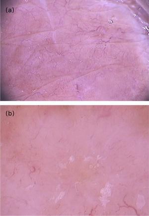 (A), Dermoscopic image of borderline tuberculoid leprosy showing yellow-orange areas surrounded by erythema and telangiectasias with linear branching; and (B), dermoscopic image of the histoid variant multibacillary leprosy showing a papular lesion with diffuse yellowish color and multiple heteromorphic telangiectasias. (B) (FotoFinder, original magnitude ×20) Source: Hospital de Clinicas de Porto Alegre collection.