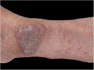 Erythematous, keloid-like papules and large tumor on the ankle.