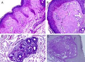 Light microscopy – (A), Eosinophilic deposits in the papillary dermis (Hematoxylin & eosin, ×150); (B), Detail of the papillary dermis with significant homogenization and vascular ectasia (Hematoxylin & eosin, ×400); (C), Discrete deposits around a sweat gland (Hematoxylin & eosin, ×400); (D), PAS staining demonstrating resistant diastase positivity in the papillary dermis (Periodic-acid Schiff ×400).