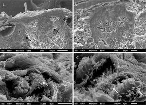 Scanning electron microscopy – (A), Small magnification showing homogenization of the papillary dermis (arrows) (×180); (B), Detail of the compact papillary dermis (×550). (C and D), Fibrillar deposits in the middle dermis (arrows) (×5,000 and 10,000).