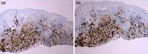 Immunohistochemical staining of the lesion. (a), Positive immunostaining for estrogen receptors (×20). (b), Positive immunostaining for progesterone receptors (×20).