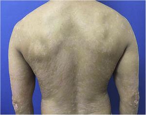 PASI 12.9, erythematous-scaling plaques.