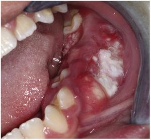 Clinical presentation: mass involving both the buccal and lingual gingiva between the lower left second molar and lower left first premolar.