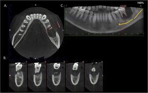 Cone-beam computed tomography. Axial (A) and para-axial (B) sections and panoramic reconstruction (C). There is a well-defined large radiolucency involving the whole thickness of the posterior left mandible perforating the buccal bone plate.