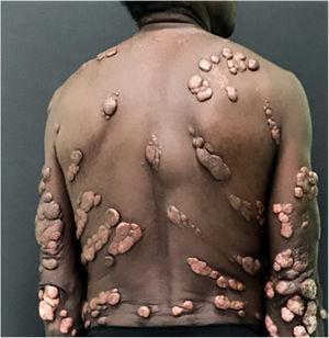 Multiple keloidal nodules and verrucous plaques disseminated on the skin.