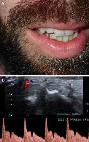 (a), Clinical photograph showing two asymptomatic, translucent, and pulsatile nodules of 1 cm each, in the left side of the upper lip. (b), Color Doppler ultrasound with spectral curve analysis confirms the arterial blood flow within the lesion.