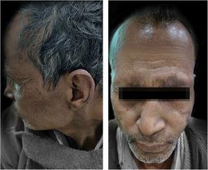 Lepromatous Leprosy with ENL showing clearance of lesions after MIP vaccination.