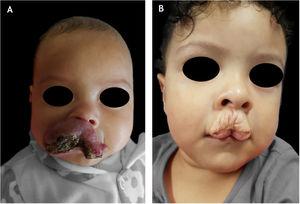 Unaesthetic sequela: (A), patient with ulcerated infantile hemangioma on the lip at 4 months of age and (B), scar and redundant skin at 2 years of age.