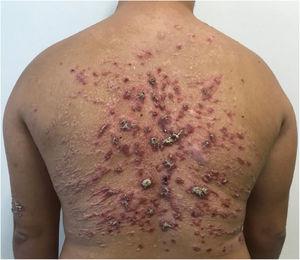 Predominance of scarring lesions after treatment with liposomal Amphotericin B, but still maintaining some active lesions (total accumulated dose of 3g).