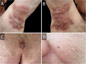 Hidradenitis suppurativa of (A), left and (B), right axillae before surgical intervention. (C), Sacrococcygeal pilonidal cyst. (D), Ice pick scar from severe acne.