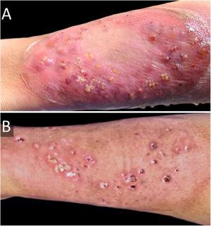 (A), Pyoderma gangrenosum (erythematous lesion with blisters, pustules, and a purplish hue) on his left leg before intravenous broad-spectrum antibiotics and topical high-potency corticosteroids. (B), One month after treatment; cribriform scarring can be seen.