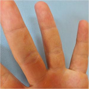 Asymptomatic, pitted, hyperkeratotic, grouped papules on the palmar aspect of the third and fourth phalanges of the left hand of a 24-year-old man.