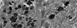 Transmission electron microscopy (A and B). Detail of melanosomes with indentations in their outline (×50,000).