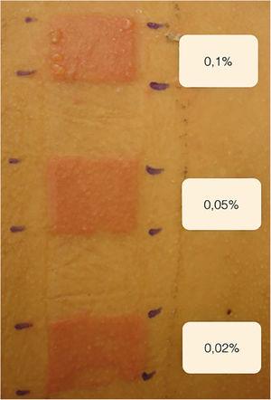 Reading of the patch test after 72 hours.