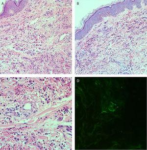 (A and B), Histopathology of the skin showing diffuse inflammatory infiltrate in the dermis (Hematoxylin & eosin, ×100). (C), Postcapillary dermal vessels permeated by neutrophils with leukocytoclasia. Presence of signs of endothelial damage with mural and interstitial fibrin deposits, in addition to extravasated red blood cells. (Hematoxylin & eosin, ×400). (D), Direct immunofluorescence showing granular deposits of IgA and IgM on the postcapillary vessel wall.