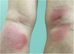 Early presentation of generalized pustular psoriasis.