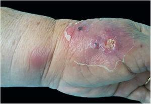 Cutaneous-lymphatic sporotrichosis. Sporotrichosis inoculation ulcer on the back of the right hand.