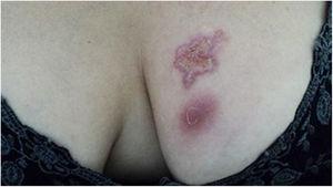 Cutaneous lymphatic sporotrichosis. Ulcerated plaque on the left breast with erythematous borders and an infiltrating nodule just below the plaque.