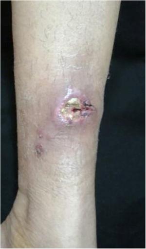 Fixed cutaneous sporotrichosis – ulcerated solitary plaque, with erythematous borders and a serous base.