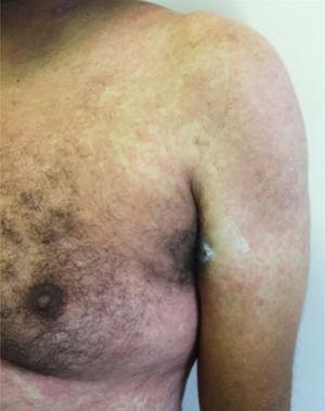 Exanthem in a patient with COVID-19.