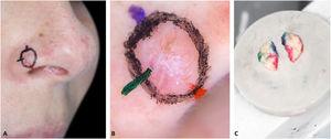 DerMohscopy. (A), Colored orientation marks. (B), Photographic documentation of the mapped dermoscopy. (C), Surgical specimen is inked with the same colors as the markings on the patient.