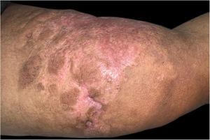 Regression of the tumors on the inner side of the right thigh after the 3rd cycle of RADHAP 21 chemotherapy.