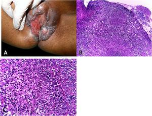 (A), Tuberculosis orificialis (tuberculosis cutis orificialis) – Ulcerovegetating lesion affecting the labia majora and minora. (B), TB orificialis – ulcerated epidermis and massive dermal granulomatous inflammatory infiltrate, (Hematoxylin & eosin, ×40). (C), TB orificialis – granuloma associated with caseation necrosis, (Hematoxylin & eosin, ×200). Pictures by: Dr. Maraya Bittencourt.
