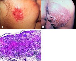 (A), Lupus vulgaris – infiltrated, eroded lesion, with sharp edges, in the right masseteric region. (B), Lupus vulgaris – extensive plaque covered with papules/nodules, scarring areas, with sharp raised edges on the right gluteal region. (C), Lupus vulgaris – the dermis shows granulomatous inflammation with foci of caseous necrosis, (Hematoxylin & eosin, ×40).