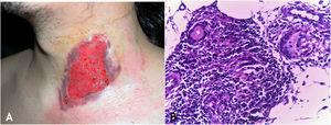(A), Gummatous TB – irregular ulcer with sharp edges on the cervical region. (B), Gummatous TB – granuloma consisting of lymphocytes, macrophages and multinucleated giant cells, (Hematoxylin & eosin, ×100).
