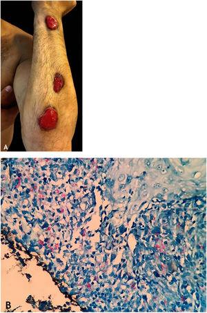 (A), Sporotrichoid gummatous TB – ulcerated lesions along the upper limb. (B), Sporotrichoid gummatous TB - numerous resistant acid-fast bacilli (AFB) in the infiltrate on Fite-Faraco staining. Pictures by: Dr. Deborah Unger.