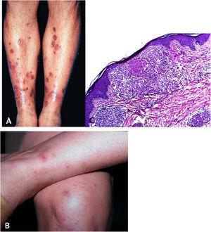 (A), Papulonecrotic tuberculid – “punched-out” lesions on the lower limbs. (B), Papulonecrotic tuberculid – papuloerythematous and papulocrustous lesions in the lower limbs. (C), Papulonecrotic tuberculid – thinning of the epidermis and granulomas with caseation necrosis in the underlying dermis, (Hematoxylin & eosin, ×20).