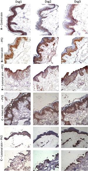 Immunohistochemistry panel with Dsg1, Dsg2 and Dsg3 expressions in skin samples (original magnification: ×40). (A), Abdominoplasty control skin sample showing typical distribution of Dsg1, Dsg2 and Dsg3 in the epidermis. (B), PF - intact skin sample showing increased expressions of Dsg2 and Dsg3 in the entire epidermis and PF - lesional skin sample showing increased expressions of Dsg2 and Dsg3 on the roof and floor of the acantholytic bulla. (C), PV-intact skin sample showing increased expression of Dsg2 and Dsg3 in the entire epidermis and PV-lesional skin sample showing increased expression of Dsg2 and Dsg3 on the roof and floor of the bulla and in the acantholytic cells.