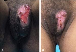(A), Extensive ulcer with crusts in the vulva. (B), Cicatricial aspect of the lesion after association with 5% imiquimod cream.