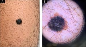 (A), Blackish papule over brownish macula on the left calf. (B), Dermoscopy.