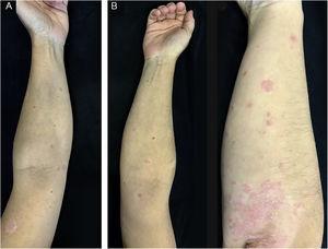 Guttate psoriasis and chronic plaque psoriasis flare (case 2): (A) Guttate psoriasis drop-like erythematous papules and plaques on the upper limbs; (B) Guttate psoriasis erythematous plaques on the upper limbs and erythematous scaly plaques on the elbows.