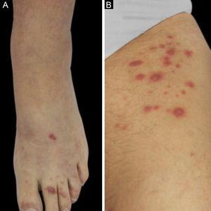 (A), First patient – Violaceous papular lesions on the dorsum of the left foot and left toes. (B), Second patient – Erythematous grouped papules on the superior portion of the left thigh.