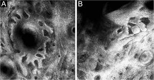 (A), Squamous hyperplasia forming irregular finger-like protrusions around the hair follicle (B), Papillomatous hyperplasia in the hair follicle epithelium on reflectance confocal microscopy.