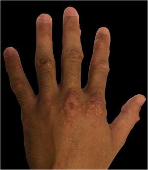 Multiple erythematous papules, with confluent areas, located on the hands.