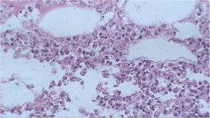 At higher magnification, the histopathological examination revealed the presence of a neutrophilic infiltrate in the hypodermis (Hematoxylin & eosin, ×400).