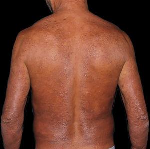 Lepromatous leprosy. Diffuse indurated erythematous-ferruginous plaque, interspersed with macules and papules, sparing the spinal column and axillary regions and predominating on the elbows.