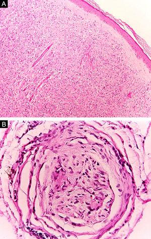 Lepromatous leprosy. (A), Rectification of the epidermis, which is separated from the dense dermal infiltrate by a collagen band (Hematoxylin & eosin, ×40). (B), Cross-section of a dermal nerve with perineural delamination (Hematoxylin & eosin, ×200).