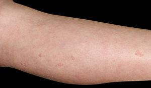 Physical examination revealed multiple reddish keratotic lesions on the right lower extremity.