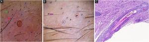 (A), Hemorhagic area (black circle), split hair (red arrow), question mark hairs (gren arrows), black dots (blue circle). (B), Broken hair (purple arrow), flame hair (red circle), black dots (blue circle). (C), Inner rooth sheath distruption, and intrafollicular pigment cast (Hematoxylin & eosin, ×100).