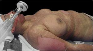 Blisters, vesicles, and detachment of the epidermis.