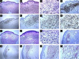 Immunohistological features of common blue nevi with HMB45 protein expression (diffuse or patchy staining patterns). (A, B and C), A case of 59-years old lady presented with 0.5 cm hyperpigmented glistening macule on the skin of the right arm. Histologically, the lesion is composed of a proliferation of spindle-shaped and dendritic melanocytes, admixed with pigment-laden macrophages (“melanophages”). Mitotic figures and junctional melanocytic activity are absent. Histologic maturation is seen at the peripheral and deep parts of the lesion, where the spindle-shaped cells insinuate themselves singly among the thickened collagen fibers of the reticular dermis. A sparse perivascular lymphocytic infiltrate is also seen. There is no individual cell necrosis or cells in mitosis. (D), Further immunohistochemical evaluation was performed with the proper positive and negative controls that revealed strong diffuse Melan-A staining. (E, F, G and H), The tumor cells show HMB45 protein expression throughout the entire lesion (diffuse pattern of staining). (I, J, K and L), A case of a 63-year-old lady with a 0.4 cm hyperpigmented macule on the chest wall. Sections show an admixture of the dendritic epithelioid melanocytes, melanophages in the mid reticular dermis amidst collagen bundles. (L), There is no mitosis or individual cell necrosis or inflammatory cell infiltrate: Further immunohistochemical evaluation was performed with the proper positive and negative controls that revealed strong diffuse Melan-A staining. (M, N, O and P), The tumor cells show diffuse HMB45 protein expression throughout the entire lesion.